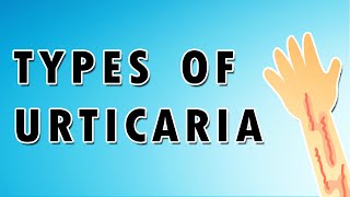 Urticaria Symptoms Treatment and Causes [upl. by Ahsiele587]