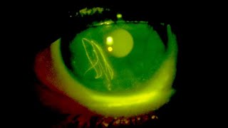 Phases of Normal Fundus Fluorescein Angiography [upl. by Ratcliff]