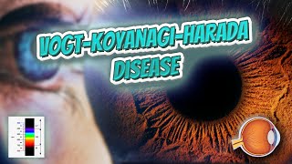 Vogt–Koyanagi–Harada disease Your EYEBALLS 👁️👁️💉😳💊🔊💯✅ [upl. by Pearce]