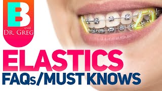 Braces Elastics  Rubber Bands – 5 Most Common Questions [upl. by Shandeigh]