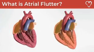 What is Atrial Flutter [upl. by Olaf]