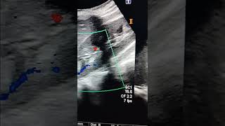 Renal Mass ultrasound abdomenangiomyolipomabening lesion [upl. by Linell]