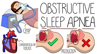 Understanding Obstructive Sleep Apnea Syndrome [upl. by Siubhan]