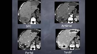 Tumeurs du foie  Bénignes  3 Hémangiome hépatique [upl. by Ahsinirt]