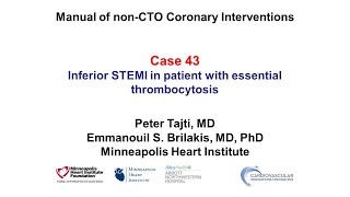 Case 43 PCI Manual  STEMI in a patient with essential thrombocytosis [upl. by Normy66]