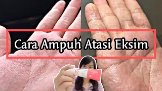 AKHIRNYA NEMU SKINCARE YANG AMPUH ATASI EKSIMKU‼️  EKSIM DISHIDROSIS  POMPHOLYX [upl. by Wilmer]