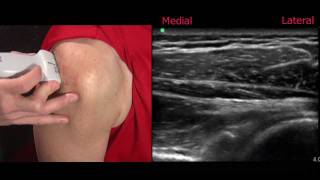 Ultrasound of the Shoulder [upl. by Susie595]