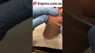 Corn and callus removal by podiatrist in thenpodiatry clinic [upl. by Dumond]