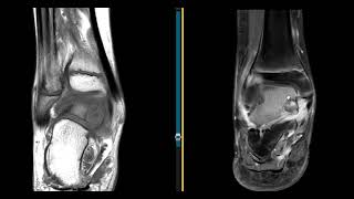 13 year old with ankle pain [upl. by Nahtanha400]