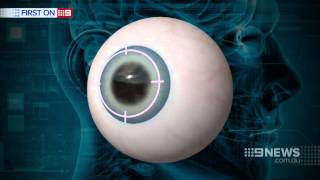 Dr Genge on 9 News  New lens implant brings clarify to cataract suffers [upl. by Lahtnero136]