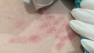 Pico Laser Clinic  Skincare Laser Clinic Point Cook [upl. by Marvella]