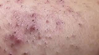 Huge blackhead removal from nose old aged blackheads removal  blackheads new this week 2023 6 [upl. by Allanson]