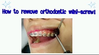 How to remove orthodontic mini screw [upl. by Vaas624]