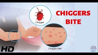 CHIGGERS BITE Everything You Need To Know [upl. by Graff85]