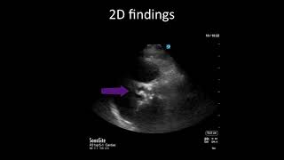 Aortic stenosis vs sclerosis [upl. by Hillier]