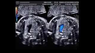 Tetralogy of Fallow with absent pulmonary valve syndrome on the 3 vessel tracheal view [upl. by Ellebanna]