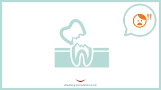 Denti che si rompono in seguito a devitalizzazione [upl. by Inkster]