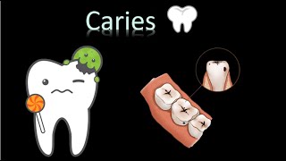 🦷 Caries Dental  Cavidad oral  Cabeza y Cuello  Patología [upl. by Leoni]