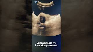 Ovarian cyst mucinous cystadenoma  ultrasonography radiology gynaecology [upl. by Aneem]