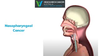 Nasopharyngeal Cancer  What Is It What are the Symptoms and Treatment Head and Neck Cancer [upl. by Esyned990]