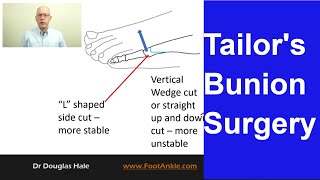 Tailors Bunion Surgery  Seattle Podiatrist [upl. by Naanac309]