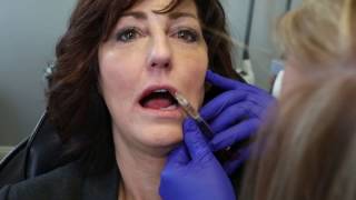 Watch Volbella Injection  Full Procedure [upl. by Rea]