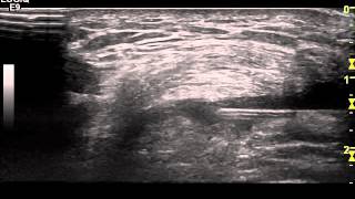 Ultrasound guided Injection of the Suprapatellar pouch Knee Dr Peter Resteghini [upl. by Zebe628]