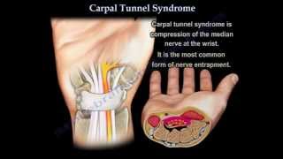 Carpal Tunnel Syndrome  Everything You Need To Know  Dr Nabil Ebraheim [upl. by Birgit956]