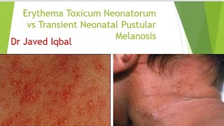 Erythema Toxicum Neonatorum VS Transient Neonatal Pustular Melanosis [upl. by Yretsym]