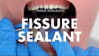 Placement of a Fissure Sealant [upl. by Rehpotsirahc]