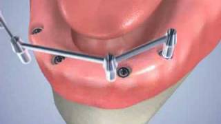 pose de 4 implants dentaires avec une barre dattachement [upl. by Monika]