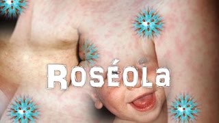 Virus Herpes Humano 6 Y 7Roseola [upl. by Yauqram]