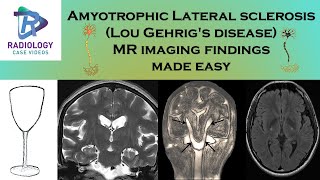 Amyotrophic lateral sclerosisLou Gehrig Disease Motor Neuron Disease MRI Made EasyIcebucket [upl. by Zurciram]