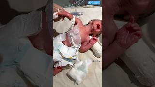 Premature baby video newbornbaby viralvideo [upl. by Ecinreb270]