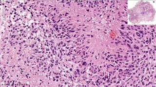 Glioblastoma  Histopathology [upl. by Nirek]