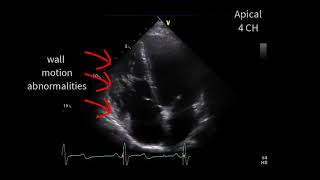 A special cardiomyopathy [upl. by Nipahc]