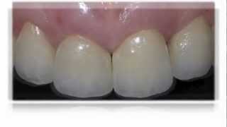 Lithium disilicate veneer and crowns [upl. by Lodovico787]