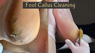 Callus Removal From Feet 👣 Foot Callus Removal Satisfying [upl. by Schonfeld]