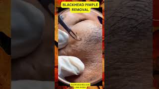 Get RID of BLACKHEADS in Just 5 Minutes [upl. by Harding]