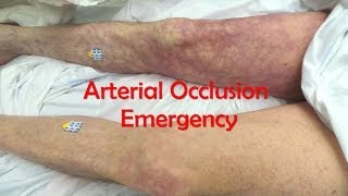 Acute Complete Occlusion of the Leg Arteries [upl. by Salis]