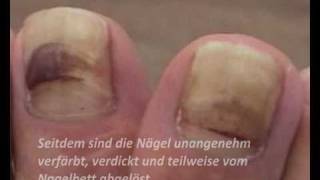 Nagelpilz Folgen sind gelbe dicke Fußnägel Was tun Das spezielle Fußnagel Spray [upl. by Allehs]