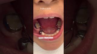 Bilateral Space maintainer braces viral orthodontist youtubeshorts dentist braces trending [upl. by Platus411]