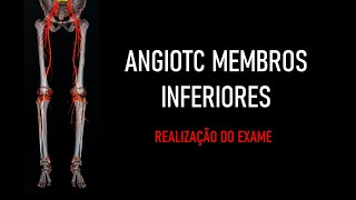 Angiotomografia Membros Inferiores REALIZAÇÃO DO EXAME [upl. by Philbert838]