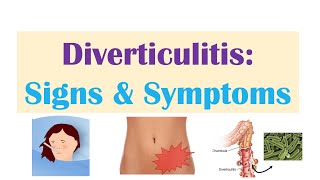 Diverticulitis Signs amp Symptoms And Why They Occur [upl. by Gittel]