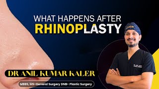 What Happen After Rhinoplasty  bodygoals rhinoplastyexpert skincare nosejob nose face [upl. by Omixam]