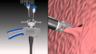 OverStitch™ Animation  Endoscopic and External Views [upl. by Lantha855]