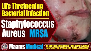 Staphylococcus Aureus MRSA  LifeThreatening Bacterial Infection  MRSA Treatment amp Prevention [upl. by Nauquf]