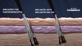 Dhi Micro Sapphire vs Fue Cosmedica Hair Transplant Dr Acar [upl. by Stafford]