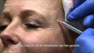 BeautyJournaal TV Actrice Inge Ipenburg krijgt Sculptra injectables [upl. by Eelegna]