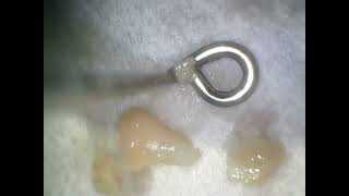 Tonsil Stone Tuesday  July 23 video [upl. by Ylrebmic]